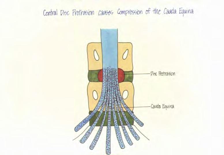 Central Disc Protrusion causes Compression of