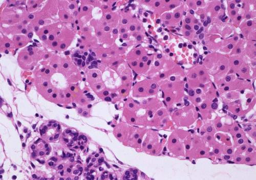 Oncocytosis vagy más néven focalis adenomatosus oncocyter hyperplasia, ez az oncocytoma, illetve multiplex