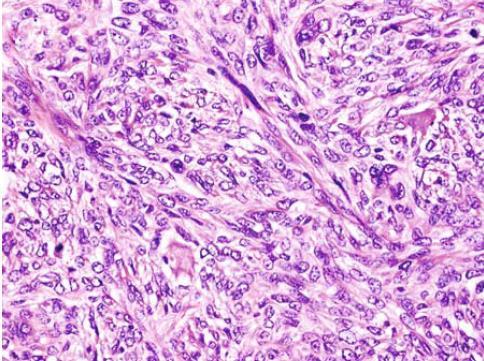 Malignus nyálmirigy tumorok Myoepithelialis carcinoma: -myoepithelioma vagy pleomorph adenoma talaján fejlődik