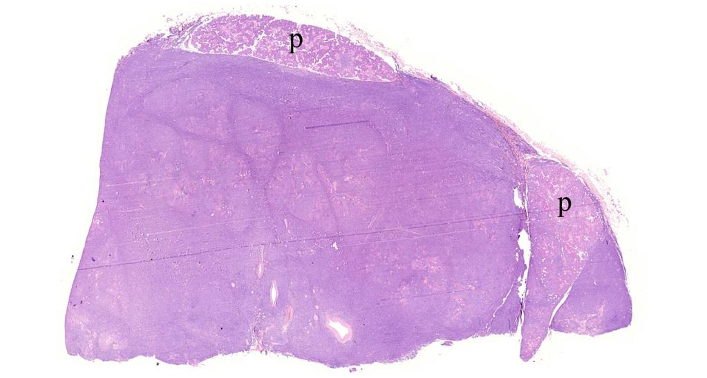 Nyálmirígy MALT lymphoma -MALT lymphoma (extranodalis marginalis zóna lymphoma), a leggyakoribb nym. lymphoma -DLBCL, FL, CLL -eredet: a nym.