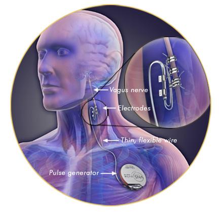 METHOD OF VNS THERAPY The VNS device is implanted under the skin on the chest wall A wire runs from