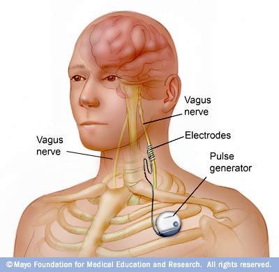 METHODS OF VNS THERAPY (CONT D) A computer is used to generate the pulses of electricity at regular