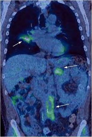 Képalkotó diagnosztika FDG-PET/CT: multifokális IgG4 asszociált megbetegdés jobb tüdő, pancreas farok, retroperitoneum érintettséggel