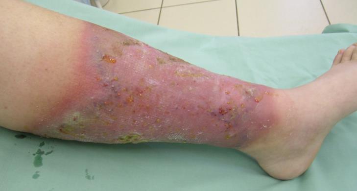 Cellulitis A cellulitis akut bakteriális fertőzés a kötőszövet mélyebb rétegeiben. Leggyakrabban krónikus seb fennállása, és nem szakszerűen kezelt krónikus bőrfertőzés előzi meg.