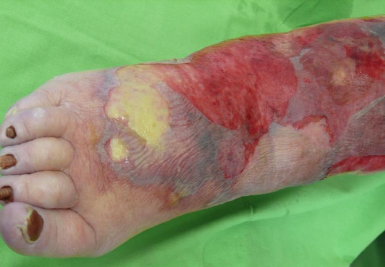 Necrotizáló fasciitis (NF) Az életet is veszélyeztető bőr-, és lágyrészfertőzés, amely a subcután szöveteket, a fasciát is érinti Rizikó faktorok: immundeficiencia, diabetes mellitus, nyiroködéma,