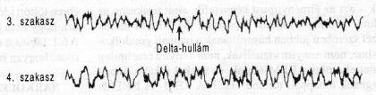3. kisebb delta hullámok: alvási orsók között 0.5-3Hz hullámok 4. nagy delta hullámok: 0.2-1Hz aktivitás A 3. és 4.