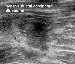 2. 56 éves nő; szűrés; 10 mm-es sugaras szélű solid képlet Szűrés: mammographia UH