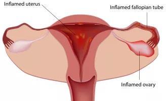 KISMEDENCEI GYULLADÁS Abscessus tuboovarialis Pelveo-peritonitis Endometritis Salpingitis Alhasi fájdalom Láz Mucopurulens folyás