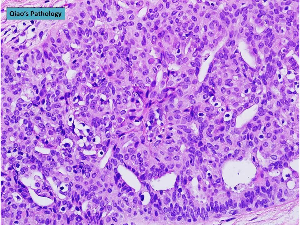 com/slides-13/slides/breast_fcc_apocrinemetaplasia.