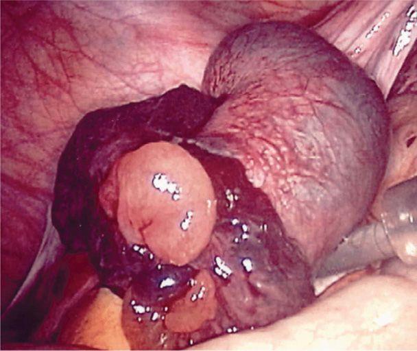 hasi/kismedencei műtét Korábbi ectopiás terhesség Petevezeték ligációja
