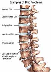 extensors like the erector spinae and inhibited and weakened gluteus maximus and abdominal muscles (14,18).