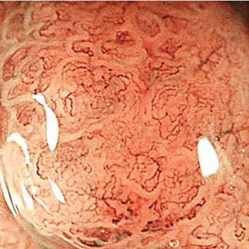 636 TEMATIKUS ÖSSZEÁLLÍTÁS ÚJ MÓDSZEREK A BELGYÓGYÁSZATI DIAGNOSZTIKÁBAN 3. ábra. Narrow band imaging technika, nagyított felvétel.