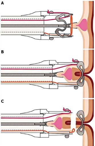 640 TEMATIKUS ÖSSZEÁLLÍTÁS ÚJ MÓDSZEREK A BELGYÓGYÁSZATI DIAGNOSZTIKÁBAN 7. ábra. Endoscopic full thickness resection.