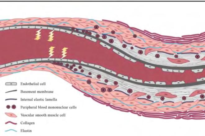 VASCULOPATHIA - SZISZTÉMÁS SCLEROSIS Kezdeti trigger? infectio környezeti faktorok anti-ec-antitest reaktív oxigén gyökök.