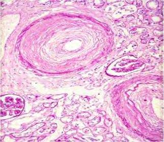 VASCULARIS TÜNETEK, MANIFESZTÁCIÓK SZISZTÉMÁS SCLEROSISBAN Vasoconstriction/Vasodilation Intima hyperplasia Media hypertrophia Fibrosis In situ thrombosis Obliterative