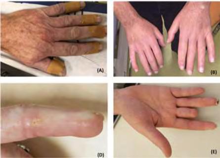 SZISZTÉMÁS SCLEROSIS VASCULARIS TÜNETEK Raynaud sy sclerodactylia o Raynaud