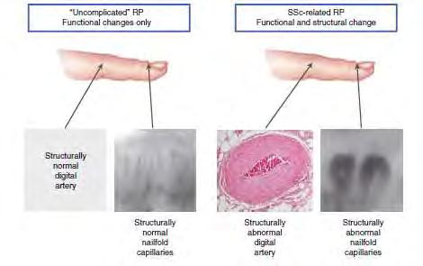 RAYNAUD SY- FUNKCIONALIS