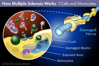 Sclerosis Multiplex Definíció: inflammatio és demyelinisatio Schneider, 2005 (demyelinizációs plakk) Prognózis: 20-30% benignus MacLean (2010): 10%
