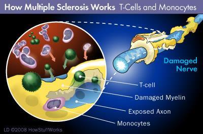 Sclerosis Multiplex Definíció: inflammatio és demyelinisatio Schneider, 2005 (demyelinizációs plakk) Prognózis: 20-30% benignus MacLean (2010): 10%