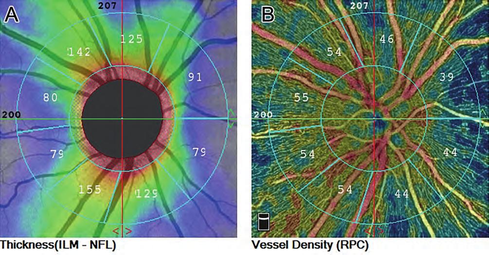 OCT angiography of the peripapillary perfusion A PERIPAPILLÁRIS RETINÁLIS IDEGROST - RÉTEG OCT ANGIO - GRÁFIÁS VIZSGÁLATA GLAUKÓMÁBAN: ALAPFOGALMAK A peripapilláris retina kvantitatív optikai