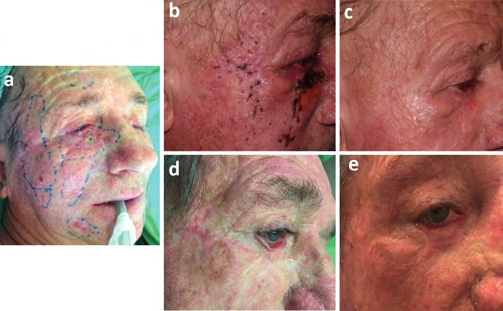 Electrochemotherapy for the treatment of periocular basal cell carcinoma 2.