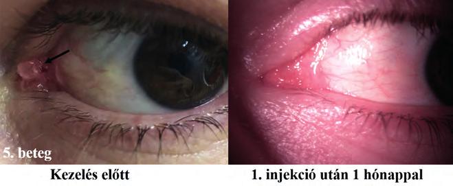 conjunctivitis, reaktív limfoid hiperplázia tartozik, a subconjunc - tivális beadási móddal kapcsolatban a kezelés napján tartó influenzaszerű tüneteket jelentettek (20).