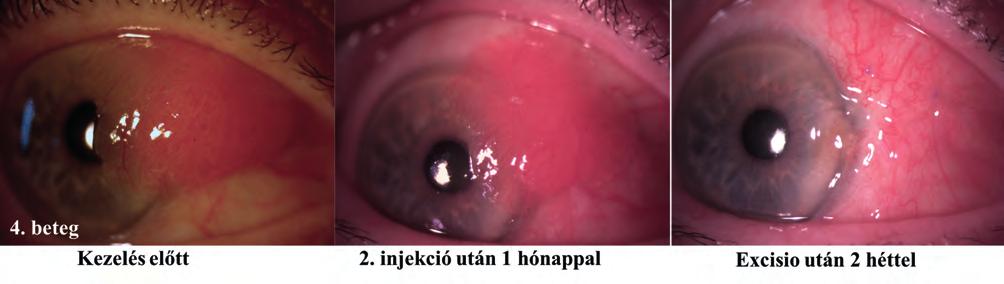 beteg kezelés előtti réslámpa fotója és in vivo konfokális mikroszkópos felvétele, amely az elváltozás területében megnagyobbodott, irreguláris epithelsejteket mutat, pleomor - phiát, magas