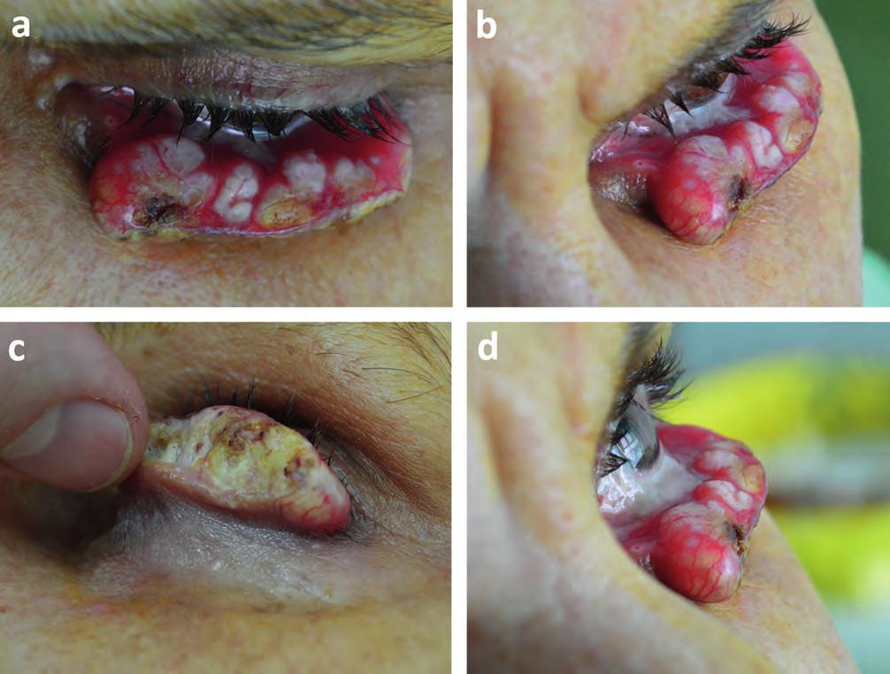 Giant keratoacanthoma of the eyelid BEVEZETÉS A keratoacanthoma egy gyorsan növekvő rosszindulatú bőrdaganat, amely többnyire a napsugárzásnak kitett bőrterületeken alakul ki, pl.