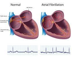 PITVARFIBRILLÁCIÓ ÉS STROKE