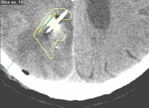 A katéter vége 4 mm-el túl van nyomva a tervek alapján meghatározott célponton (egyes számmal jelölt zöld kereszt). A katétert 4 mm-rel vissza kellett húzni.