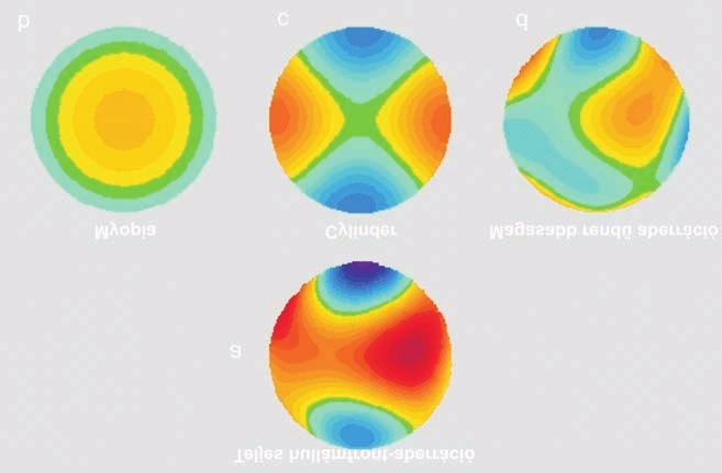 SZEMÉSZETI KÖTELEZÕ SZINTEN TARTÓ TANFOLYAM vel kiszûrhetõk a keratoconusos esetek (kezdeti stádiumú, tünetszegény keratoconus), az ilyen pácienseket nem szabad megoperálni, mivel a centrális