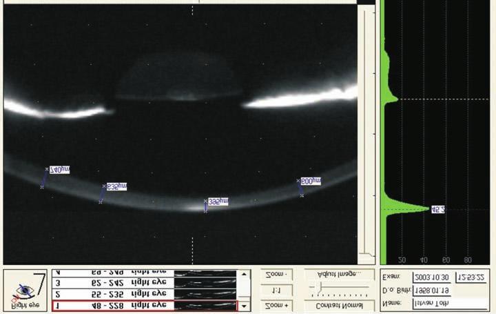 KORSZERÛ ISMERETEK A SZEMÉSZETBEN 10. ábra Ugyanezen keratoconusos szem nagyított Pentacames képe. A cnetrum a legvékonyabb, a periféria felé növekszik a szaruhártya vastagsága. 11.