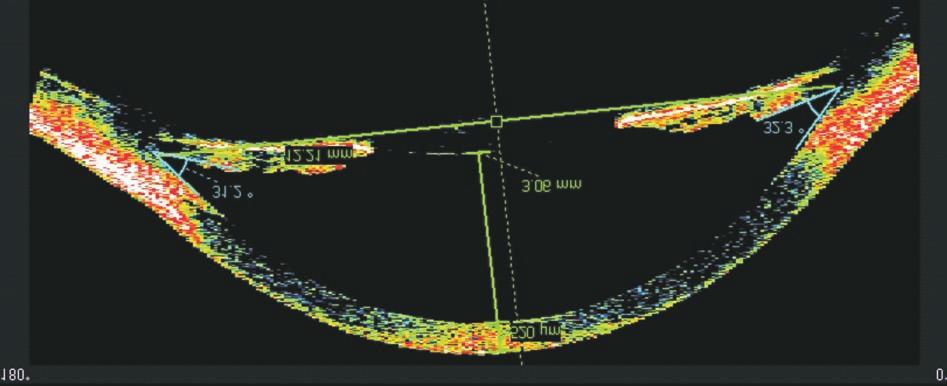 A legújabb készülékekkel a szem elülsõ szegmentumának részletei is vizsgálhatók az ultrahang biomikroszkóphoz hasonlóan, de annál részletdúsabban (pl.