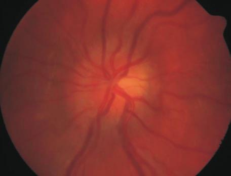 A szövõdményes szürkehályog a gyermekkori cataracta és gyulladásos cataracta kezelésének nehézségeit egyesíti magában (5). A kezelés jellegzetességei 2. ábra 3.