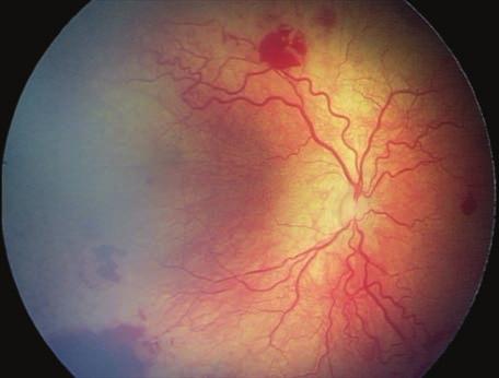 SZEMÉSZETI KÖTELEZÕ SZINTEN TARTÓ TANFOLYAM Retinopathia praematurorum Retinopathy of prematurity Maka Erika Semmelweis Egyetem, Szemészeti Klinika, Tömõ utca Kulcsszavak: koraszülött, demarkációs