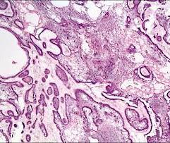 Plexiform ameloblastoma - anastomozáló