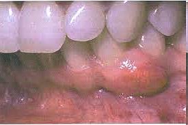 Perifériás (extraossealis) ameloblastoma - gingivalis tumor (nem érinti a csontot!