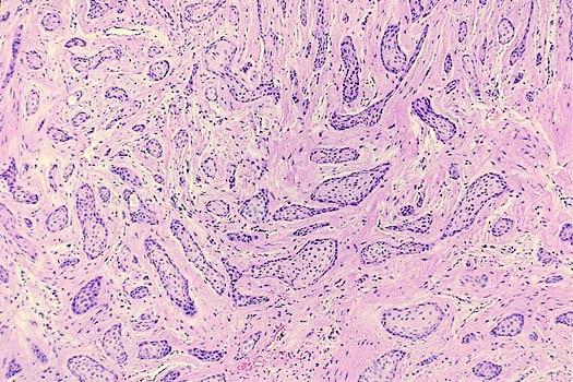 Squamosus odontogen tumor (odontogén laphámtumor) - ritka - minden korban előfordul