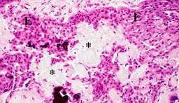 Calcifikáló epithelialis odontogen tumor (=