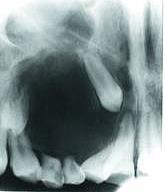 Calcifikáló cysticus odontogen tumor ** (Gorlin-cysta) Dentinogen szellemsejtes tumor