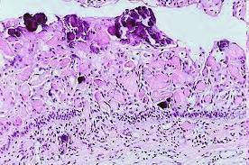 multilocularis felritkulás - basalis, ameloblast-szerű sejtek - laza, csillag-alakú