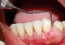 Odontogén fibroma - mesenchymalis dentalis