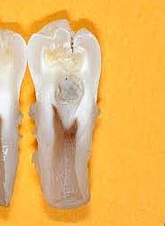 Dens invaginatus (dens in dente) Korai fogfejlődési