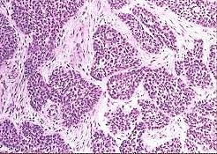 Ameloblastos carcinoma Follicularis v.