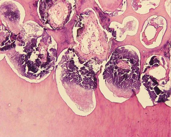 4. Complex odontoma (dentalis hamartoma) - tumorszerű képlet, szabálytalanul rendeződő