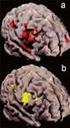 A Multislice CT jelentősége a hasi aorta aneurysma vizsgálatában