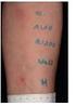 Gyógyszerallergia, anaphylaxia Dr. Bata-Csörgő Zsuzsanna