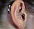 Egyéni hallókészülék-család Fülkagyló (CE), Hallójárati (CC), Mélyhallójárati (CIC) készülék