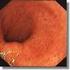 A Colitis ulcerosa diagnosztikája és kezelése