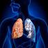 Asthma-COPD overlap szindróma